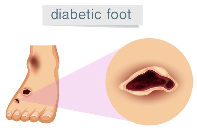 El pie diabético: prevención efectiva con cremas con urea