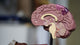 Salud neurológica y tumor cerebral